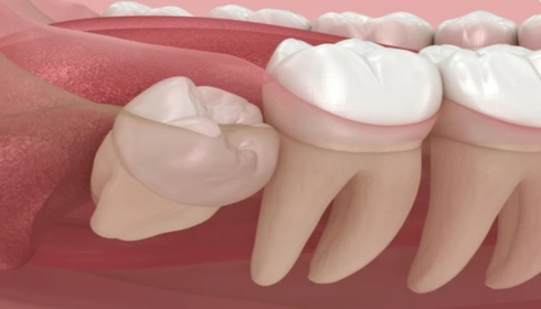 Early Signs That Wisdom Teeth Are Causing Trouble in the Back of the Mouth